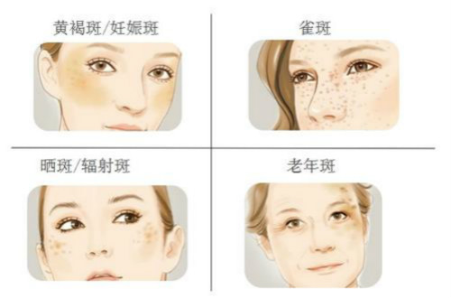 如何祛曬斑？有哪些簡單實用的辦法？